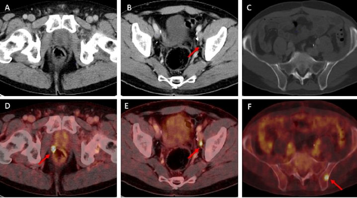 Examples of individual minor and major therapeutic change in patients with biochemical recurrence after radical prostatectomy undergoing F-18 rhPSMA 7.3 PET/CT examination