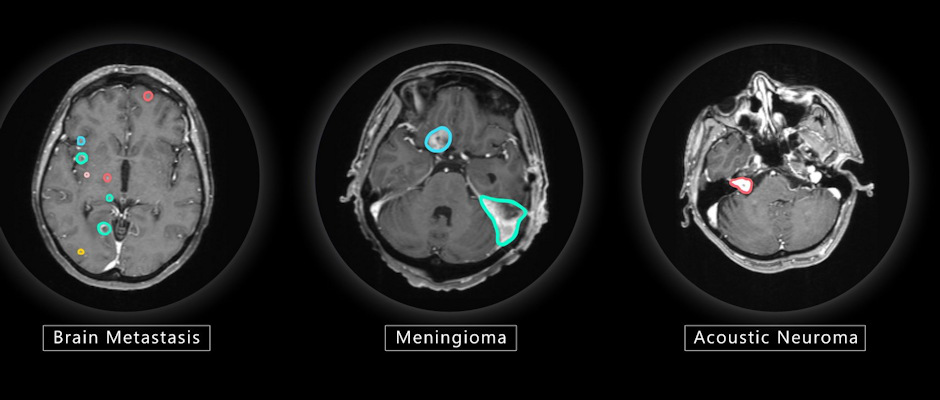 VBrain applies autocontouring to the three most common types of brain tumors