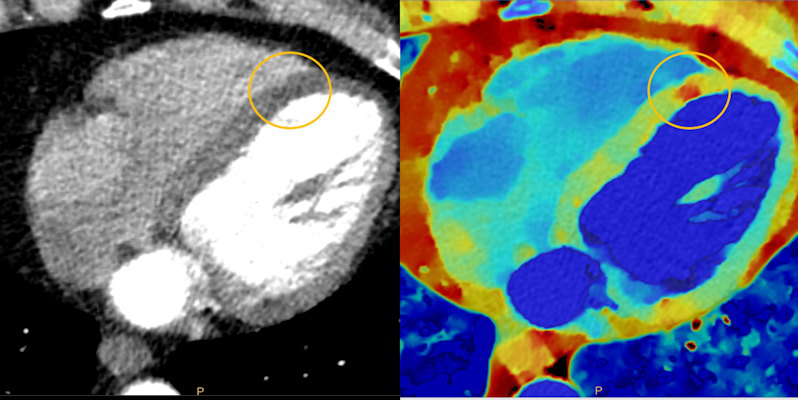 Myocardial perfusion defects are difficult to visualize on conventional CT due to beam-hardening artifacts