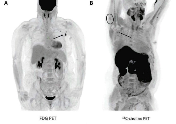 Image of a 57-year-old woman with right upper arm melanoma who received the first dose of the COVID-19 vaccine in the left deltoid 15 days prior to FDG PET/CT and image of a 62-year-old man with metastatic prostate carcinoma who received the second dose of COVID-19 vaccine in the right deltoid seven days prior to C-11 choline PET/CT