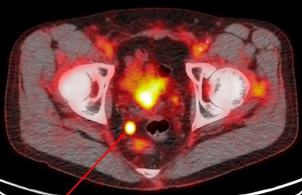 Image acquired with Pylarify demonstrates radiotracer uptake in right perirectal lymph node
