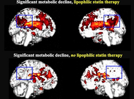 Significant metabolic decline in the posterior cingulate cortex in lipophilic statin users after five to six years compared with hydrophilic statin users and those not taking statins
