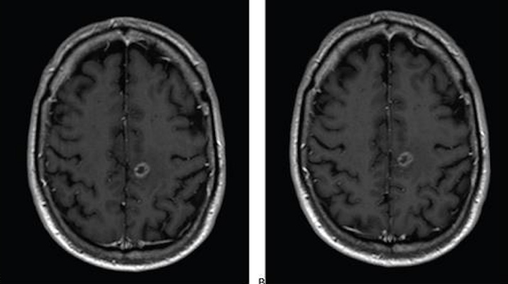 Axial T1-weighted MR images obtained using standard-dose gadoterate and reduced-dose gadobutrol four days later
