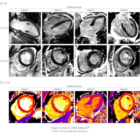 Cardiac MRI scans of patients with acute myocarditis following COVID-19 vaccination