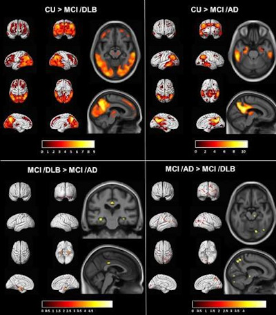 Voxel-based analysis comparing standardized uptake value ratio on FDG-PET scans of patients with mild cognitive impairment and dementia with Lewy bodies, mild cognitive impairment and Alzheimer