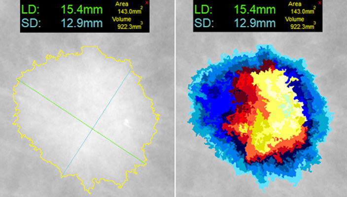 At left, one-click segmentation and measurement rendered by DL Precise. At right, DL Precise uses vivid color to illustrate segmentation. Image courtesy of DL Precise