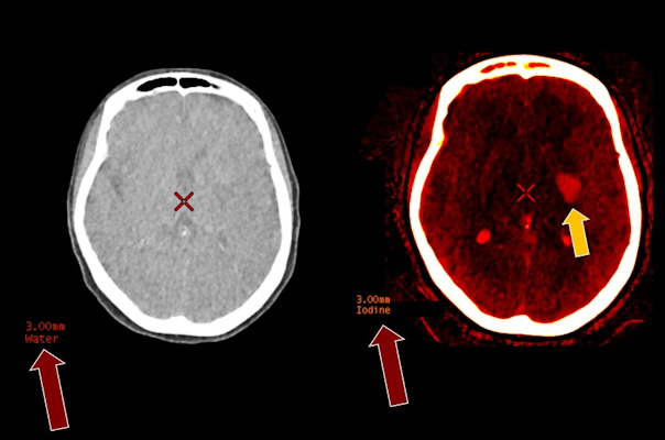 CT hyperdensity in left basal ganglia following thrombectomy could be iodine staining or postprocedure hemorrhage