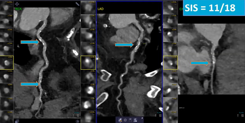 A 56-year-old patient with a clinical history of hypertension, diabetes, and dyslipidemia. Cardiac CT angiography showed obstructive stenosis. The segment involvement score was 11