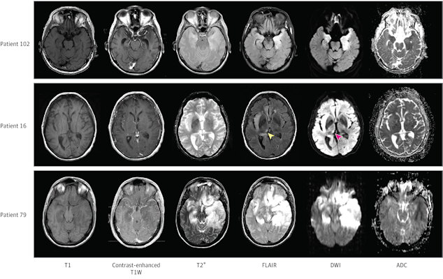Patient 102 had bilateral but asymmetrical hyperintensities in the temporal lobes seen on fluid-attenuated inversion recovery images and diffusion-weighted imaging magnetic resonance imaging sequences