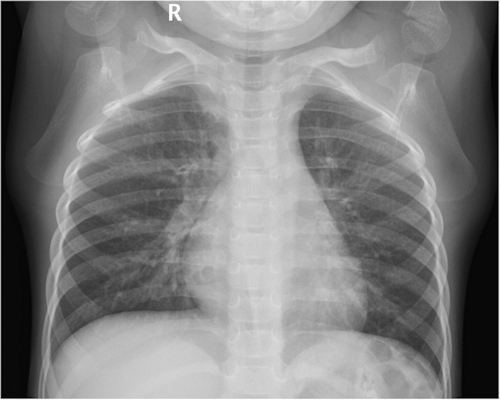Digital chest x-ray of a pediatric participant in the supine anterior-posterior projection group