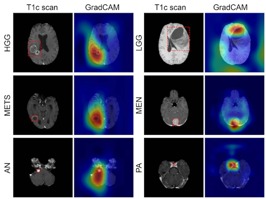 Figure shows coarse attention maps generated using gradient-weighted class activation mapping for correctly classified high-grade glioma, low-grade glioma, brain metastases, meningioma, acoustic neuroma, and pituitary adenoma
