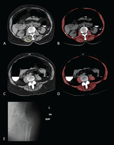 Sarcopenia at screening CT colonography in 79-year-old woman with subsequent hip fracture