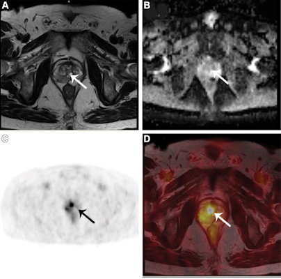  Axial T2-weighted axial apparent diffusion coefficient map, Ga-68 PSMA PET, and fused T2-weighted and Ga-68 PSMA PET/MRI scans in a 64-year-old man with a PI-RADS grade 3 lesion in the right transition zone at multiparametric MRI