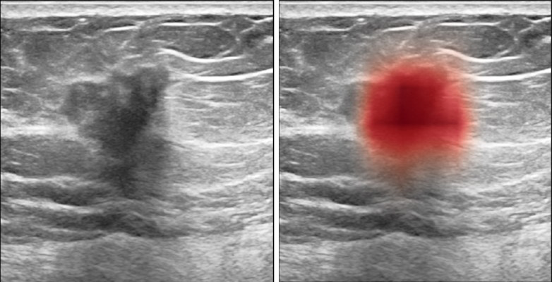 Breast ultrasound images show cancer