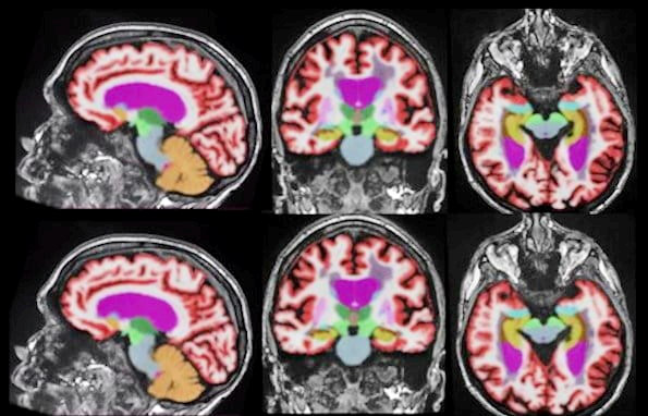 AI-based image reconstruction enables significantly faster brain MRI scan times while maintaining quantification accuracy and enhancing image quality