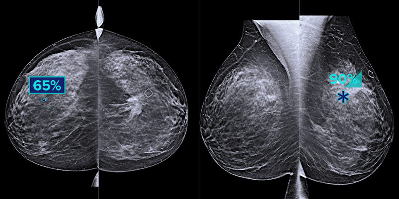 Hologic Genius AI software highlights suspicious areas of interest on breast tomosynthesis exams