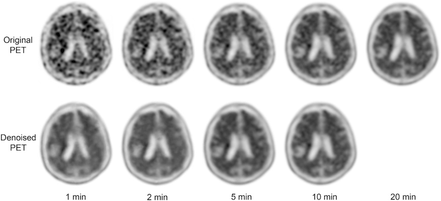 Visual comparison of reduced scan time PET images before and after denoising by MCDNet-2