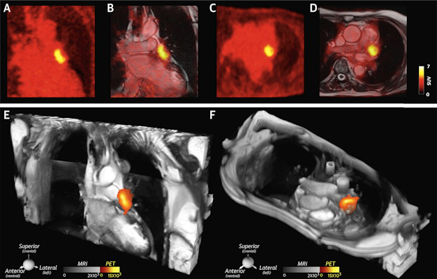 A large thrombus is seen in the left atrial appendage behind the device on the coronal PET and PET/cardiac MRI images as well as the axial PET and PET/cardiac MRI images
