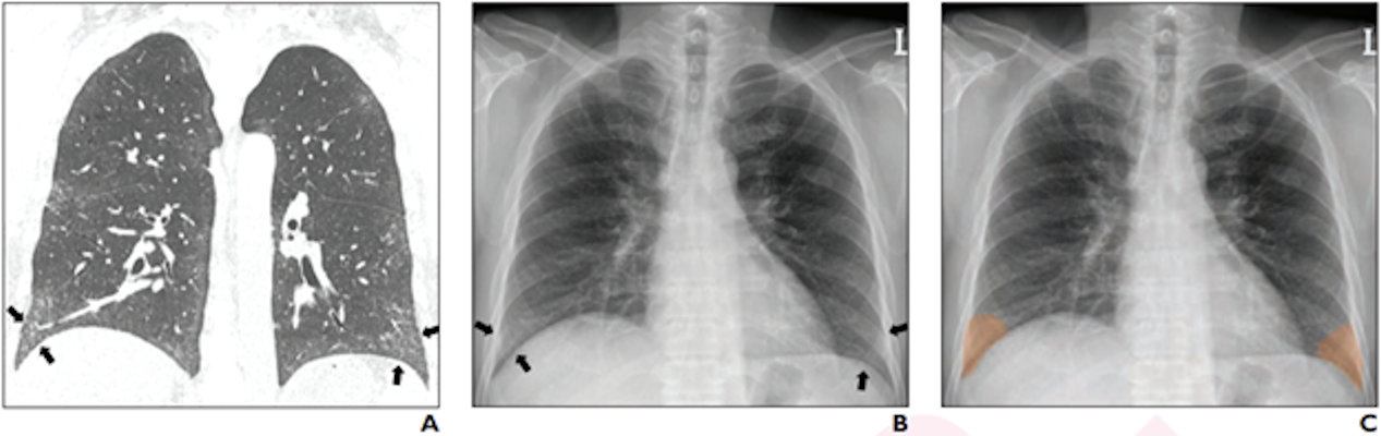 Coronal chest CT shows bilateral lower lobe pleural-based mild reticular opacities with traction bronchiectasis