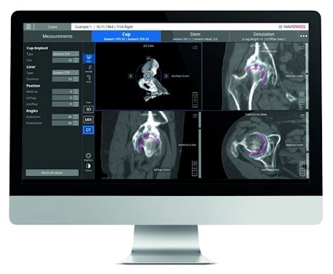 Naviplan is a digital preoperative planning application for orthopedic surgeons