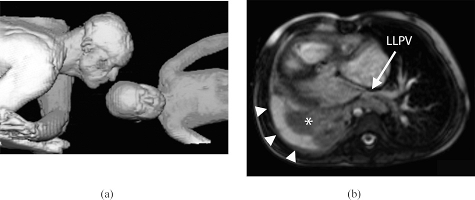 Volume-rendering reconstruction of father and daughter in MRI scanner bore