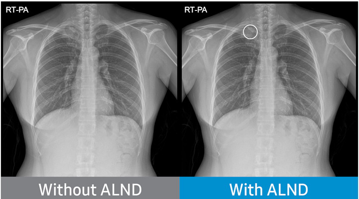 Chest radiograph without Auto Lung Nodule Detection