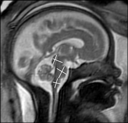 MRI showing that fetal brains had age-appropriate developments even as their expectant mothers presented with mild to moderate COVID-19 symptoms