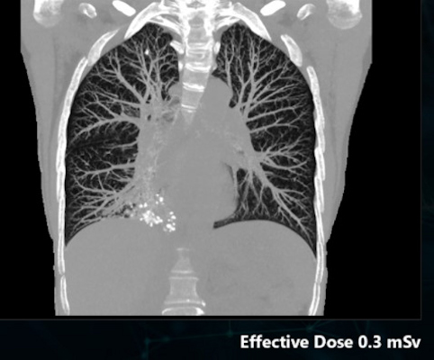 A CT lung cancer screening image acquired with Canon