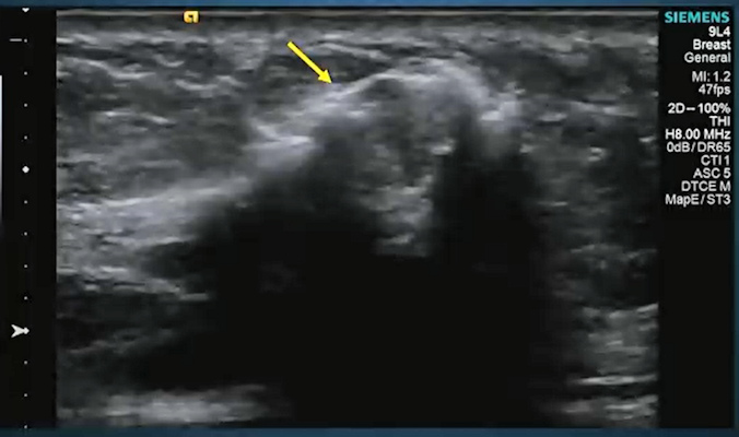 Sentinel lymph nodes can be identified through contrast-enhanced ultrasound lymphosonography