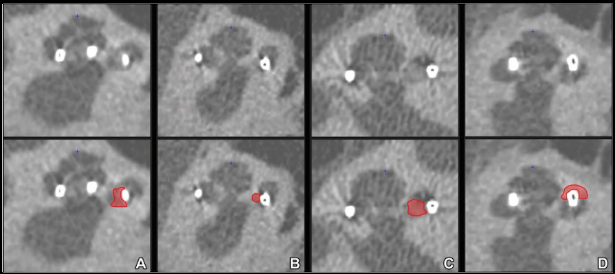Midmodiolar ultrahigh-spatial-resolution CT scans with corresponding annotations indicating new bone formation In red