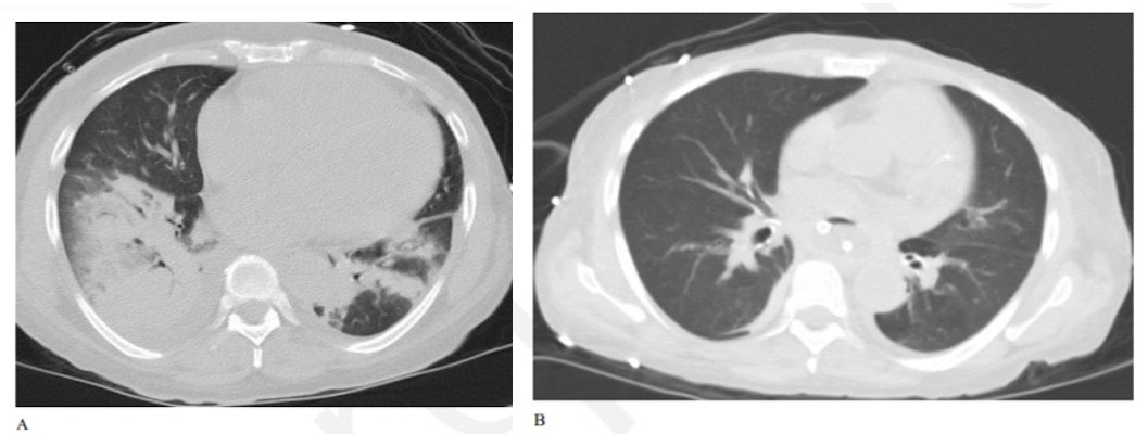 Axial chest CT on lung windows of a patient at presentation demonstrates bilateral right greater than left lower lobe consolidations with surrounding ground-glass opacities