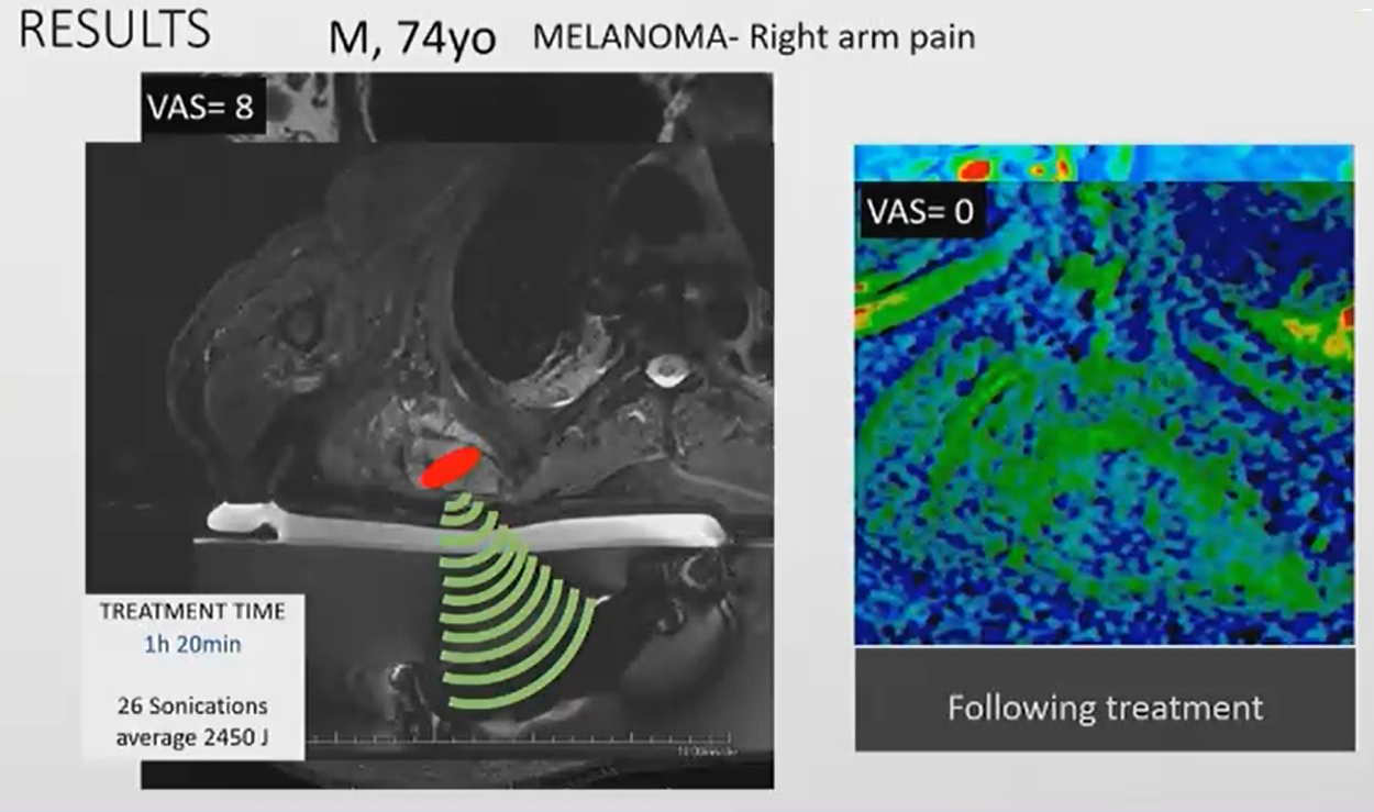 MRI-guided focused ultrasound can be an alternative method for palliative treatment of cancer patients with bone metastases