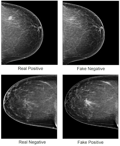 Mammogram images showing real cancer-positive and cancer-negative cases