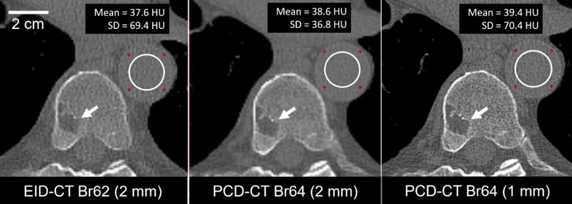 A 74-year-old male clinically indicated for a whole-body low-dose CT skeletal survey for multiple myeloma