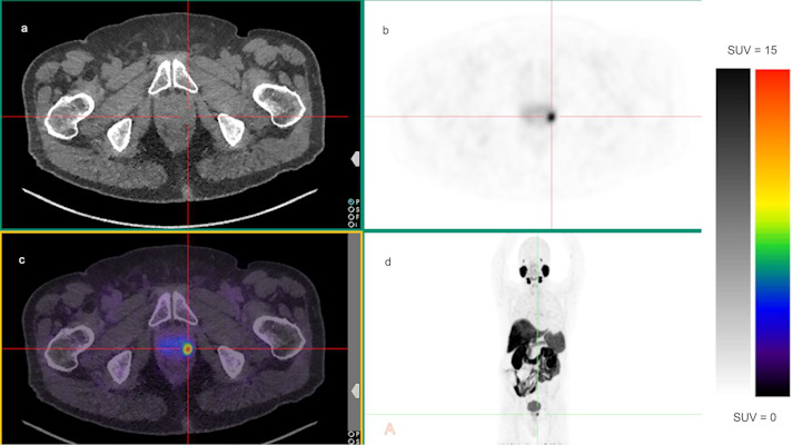 A 70-year-old male with unfavorable intermediate-risk prostate cancer who underwent F-18 PSMA-1007 PET/CT that showed a solitary F-PSMA-avid focus within the left midposterolateral prostate gland