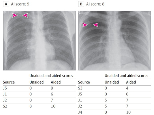 Artificial intelligence helped detect right upper lobe nodules for three junior radiologists and improved the confidence score for one senior radiologist