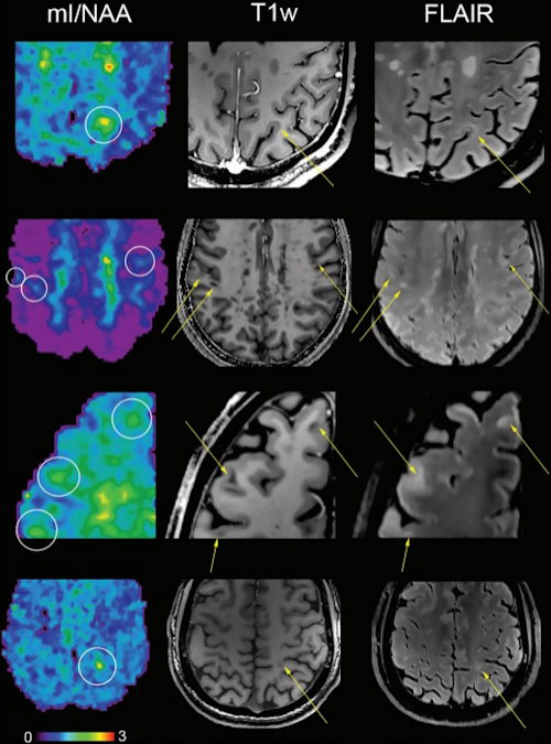 Metabolic maps showing the ratio of myo-inositol to N-acetylaspartate clearly depict small subcortical or juxtacortical lesions that appear inconspicuous at T1-weighted MRI and fluid-attenuated inversion-recovery imaging