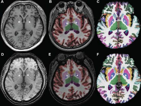 Axial MR images at basal ganglia in a 63-year-old woman with subjective cognitive impairment