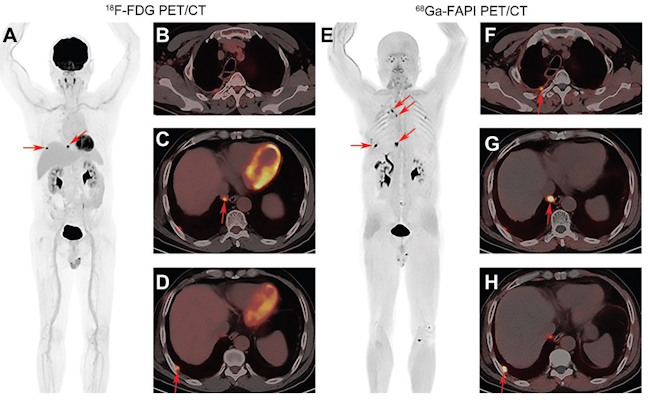 Images of a 56-year-old man with lung adenocarcinoma for tumor restaging after treatment