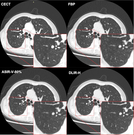 Chest CT images from deep learning image reconstruction