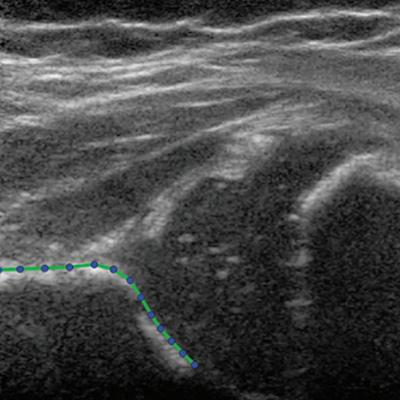 Hip ultrasound image in a 3 month old girl at baseline