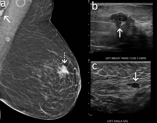 A 60-year-old woman underwent screening mammography nine weeks after receiving her second dose of the Moderna COVID-19 vaccine