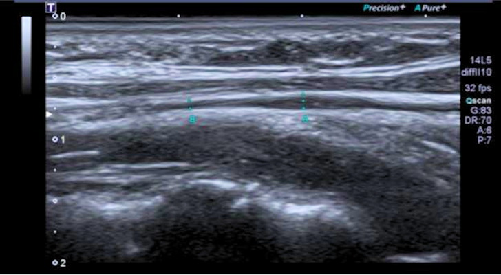 Ultrasound images show longitudinal section of the left vagus at the cervical level