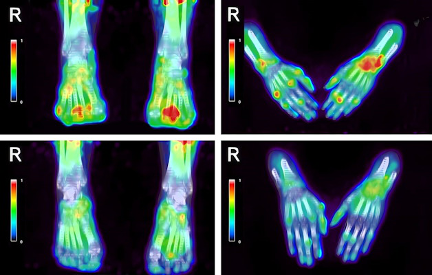 Decrease of R-(C-11) PK11195 uptake in the hand and feet joints of a patient with rheumatoid arthritis (RA) with polyarthritis