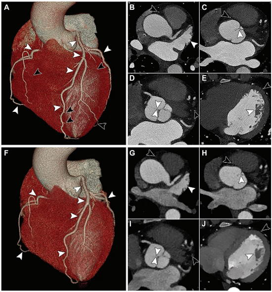coronary photon-counting CT and energy-integrating detector dual-layer CT angiography in a 44-year-old woman