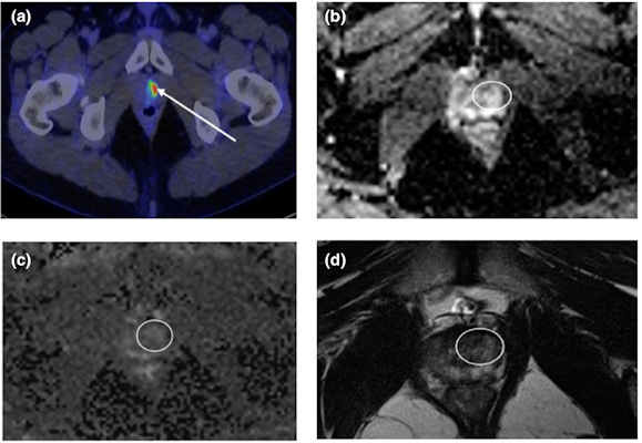 Axial fused F-18 DCFPyL PET/CT through the prostate gland apex demonstrates significant avidity in location of pathologically proven 2-mm ISUP 5 left transition zone tumor