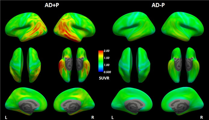 Cortical uptake of flortaucipir F-18 tracer in the form of SUVR referenced to whole cerebellum cortex for each group in the study