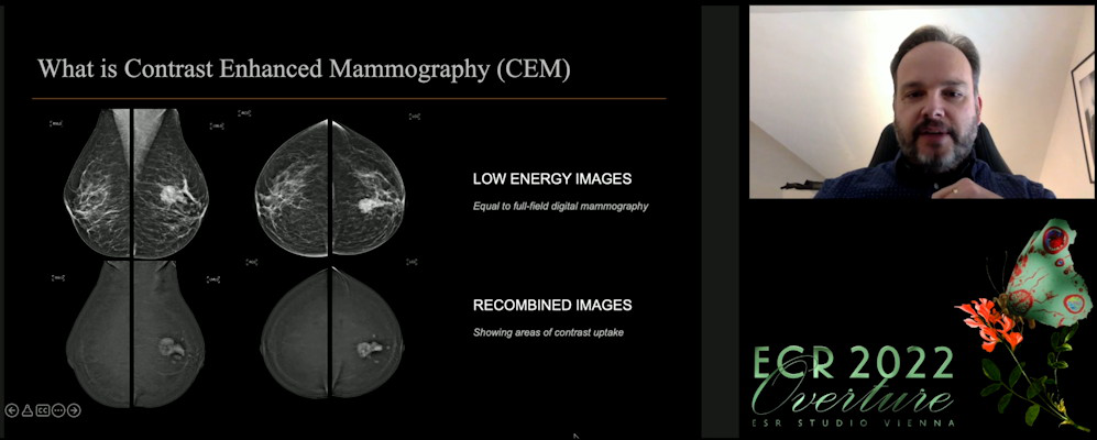 Marc Lobbes vouched for contrast-enhanced mammography