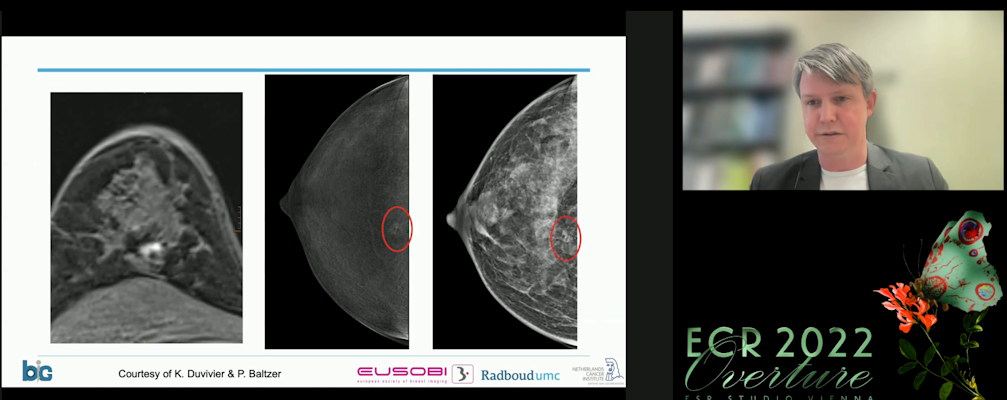Ritse Mann threw his support for breast MRI in a special pros and cons debate session at the ECR Overture on March 2