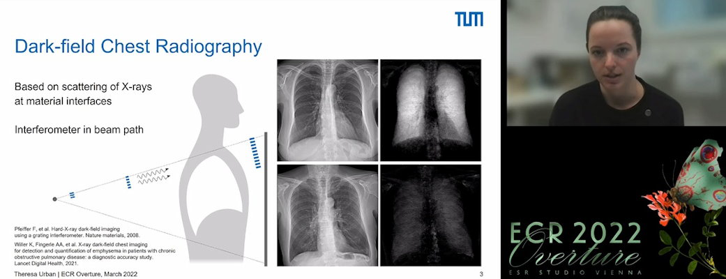 Doctoral candidate Theresa Urban of the Technical University of Munich presented the first clinical trial evidence evaluating dark-field chest radiography during ECR 2022 Overture